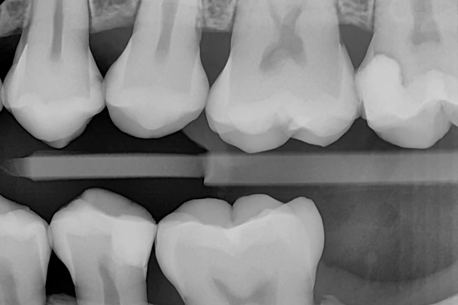 رادیوگرافی بایت وینگ چیست؟